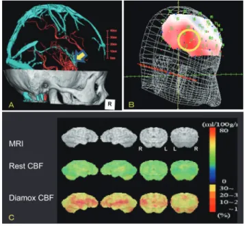 Fig. 3  The 3D fusion image of optical topography based on  Oxy-Hb and MRI during task accomplishment