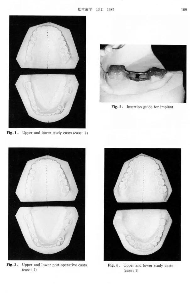 Fig. 1 . Upper and lower study casts (case:1)