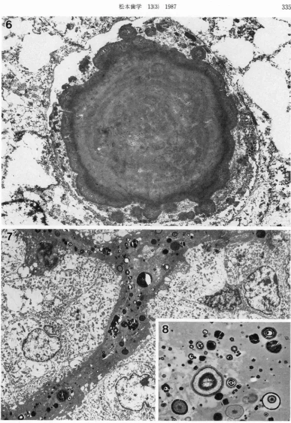 Fig. 7 : Electron-dense granules scattered in fibrous connective tissues. (case 1, TEM x3,100) Fig