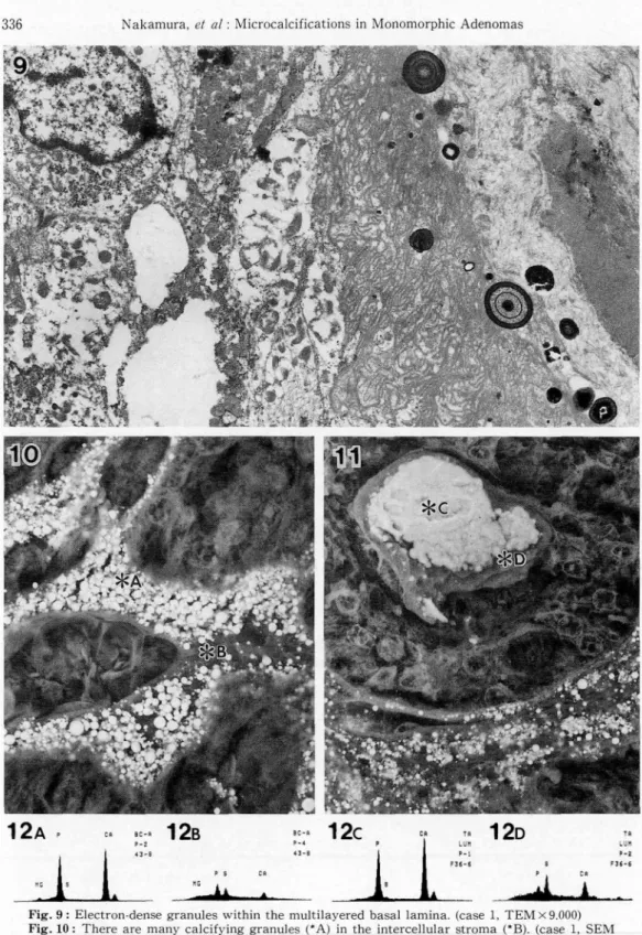 Fig. 9 : Electron-dense granules within the multilayered basal lainina. (case 1, TEMÅ~9.000) Fig