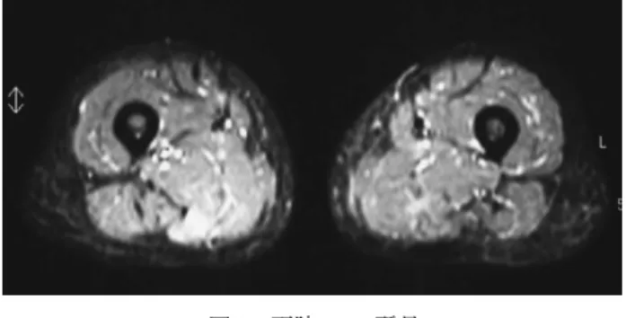 図 3 下肢 MRI 所見