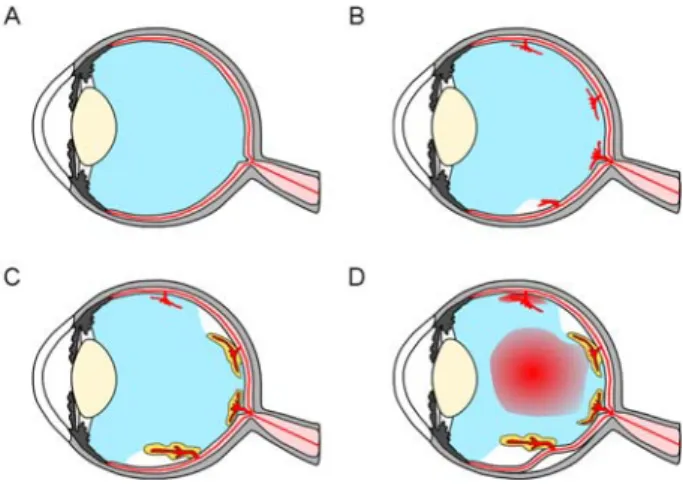 Fig.  3    The process of vision loss caused by retinal  neovascularization. 