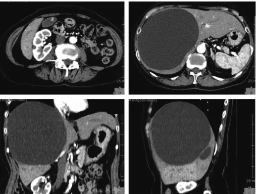 Fig. 2　MRCP showed that the intrahepatic bile  duct was strongly compressed by the liver cyst