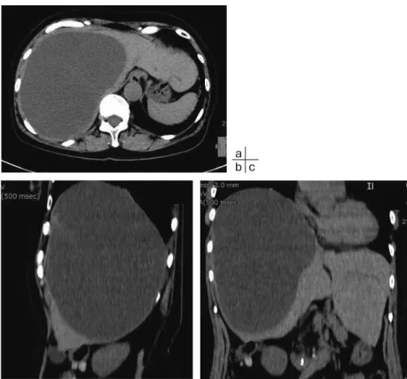 Fig. 3　An enhanced abdominal CT scan showed a simple huge hepatic cyst  with a maximum diameter of 190mm in the right hepatic lobe with no nodules  or calcifications.