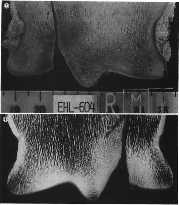 Fig.  3.  Distal  end  of  right  third  metatarsal  bone  (Mt ‡V)  with  longitudinal  fracture 