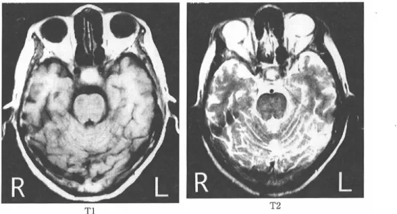 Fig.  3  Lateral  skull  X-p  shows  clearly  ballooned  Sella Turcica.