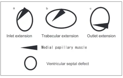 Fig. 4  The relations with the extension direction of ventricular septal defect  and attachment position of medial papillary muscle.