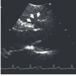 Fig. 6  Two-dimensional  images  from  left  parasternal projection (LV long-axis view)  of  an  infundibular  ventricular  septal   de-fect