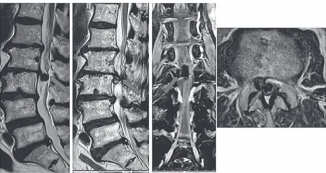 図 2 　腰椎 MRI：L2/3 腰椎椎間板ヘルニアを疑う所見