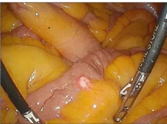 Fig. 1 Intraperitoneal  findings  during  urologic  surgery.  A  5- 5-mm  white  mass  was  found  on  the  serosal  surface  of  the  small intestine.