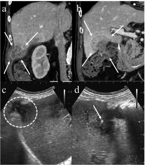 Fig. 3 – A 78-year-old man with dropped gallstones (case 3). Two irregular-shaped masses with multilocular fluid collection and thick septation that invaded the liver, abdominal wall, and colon were seen in the right Morrison’s pouch (a: arrow) and the gal