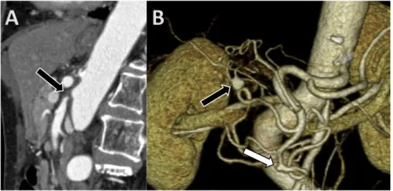 Fig. 1 Contrast-enhanced computed tomography before endovascular treatment 