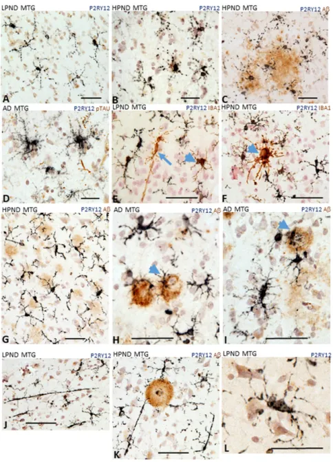 Figure 5. Different microglial morphologies associated with P2RY12 expression. Representative immunohistochemistry results of tissue sections stained to identify P2RY12 (purple) alone and Aβ (brown), IBA-1 or phosphorylated tau