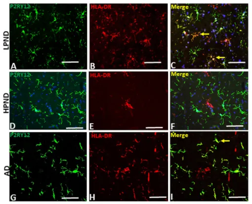 Figure 5. Different microglial morphologies associated with P2RY12 expression.  Representative  immunohistochemistry results of tissue sections stained to identify P2RY12 (purple) alone and Aβ  (brown), IBA-1 or phosphorylated tau