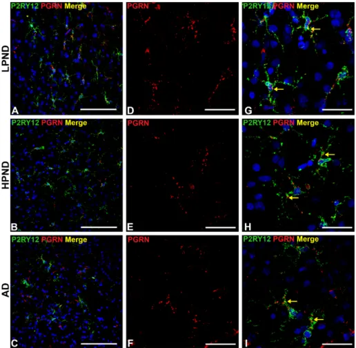 Figure 8. Confocal microscopy of P2RY12 and progranulin-positive microglia in pathologically staged  cases