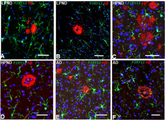 Figure 9. Interaction of P2RY12-positive microglia with different types of Aβ-positive plaques in  pathologically-staged cases