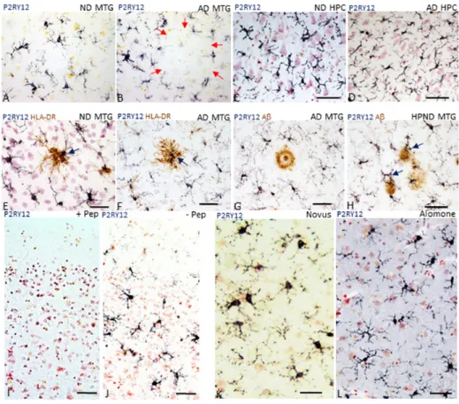 Figure 1. Features of P2RY12-immunoreactive microglia.  (A,B). Morphology of P2RY12- P2RY12-immunoreactive microglia (purple) in a low plaque non-demented (LPND) case (A) and AD case (B)