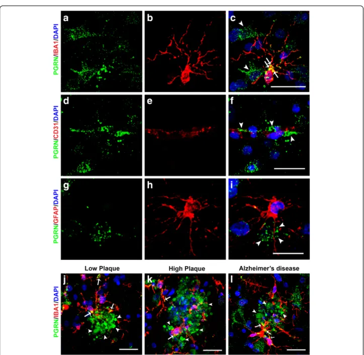 Fig. 2 Confocal Immunohistochemistry of progranulin with cellular markers. (a-c). Cellular expression of PGRN (green) (a), microglial marker IBA-1 (red) (b) and colocalization of structures within microglia (yellow) (c) in a high plaque case