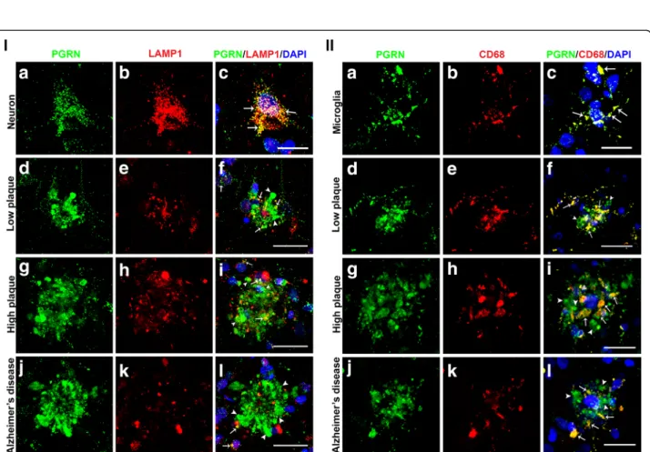 Fig. 5 Association of progranulin with lysosomal proteins. i) Progranulin and Lysosomal-Associated Membrane Protein-1 (LAMP-1) interactions in neurons and plaques
