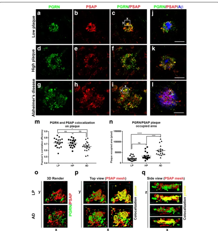 Fig. 9 Analysis of PGRN and PSAP colocalization on A β plaques in MTG tissue sections