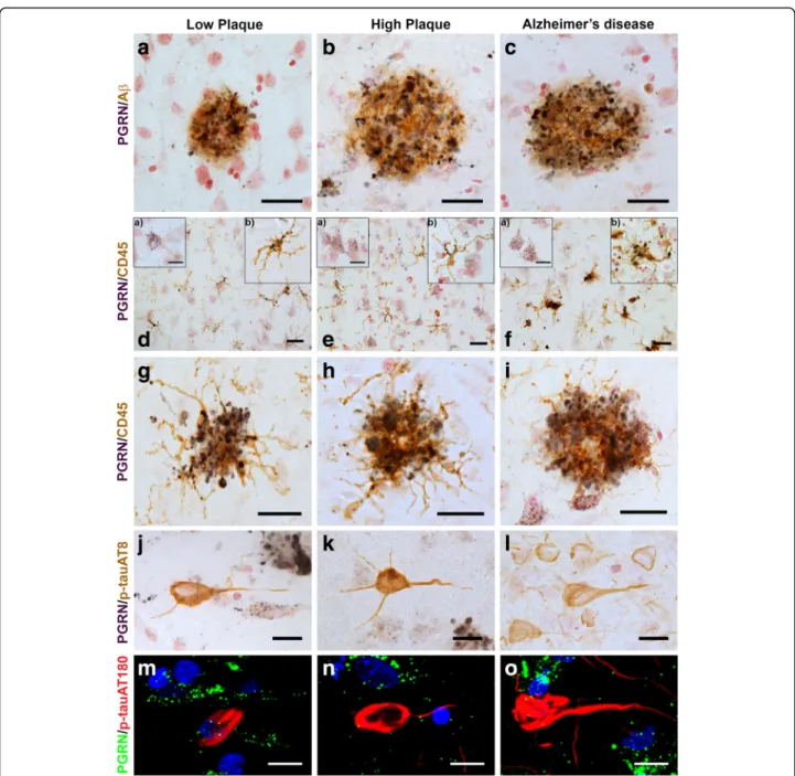 Fig. 1 Progranulin Interactions with AD pathological Features. (a-c). Representative photomicrographs of progranulin (PGRN)(purple)