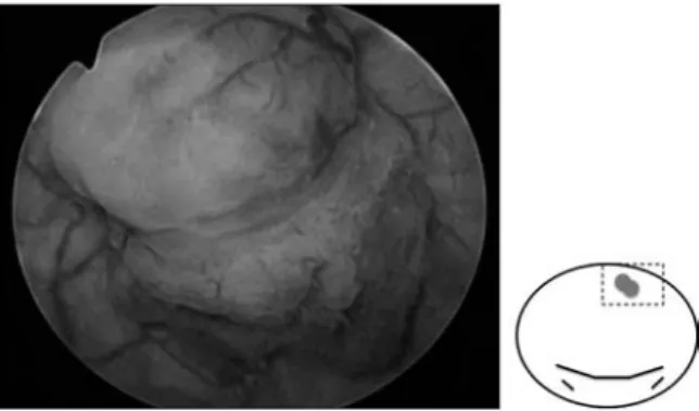 Fig. 1. Cystoscopy revealed an isolated nodular tumor 11 millimeters in diameter.