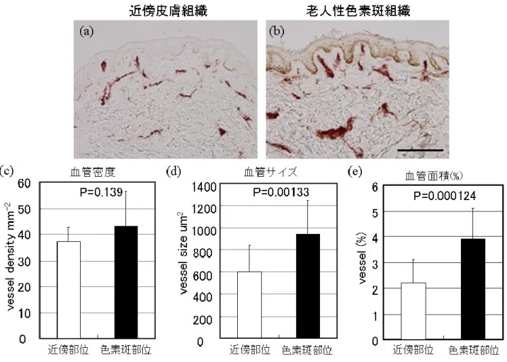 図 8   老 人 性 色 素 斑 に お け る 血 管 拡 張