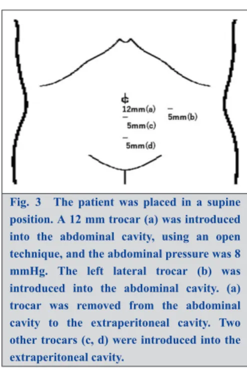 Fig. 3 The  patient  was  placed  in  a  supine position. A 12 mm trocar (a) was introduced into  the  abdominal  cavity,  using  an  open technique, and the abdominal pressure was 8 mmHg