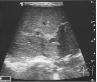 図 4-2  Triangular cord sign 