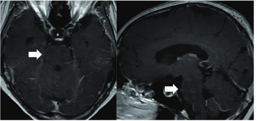 Fig. 2. Contrast-enhanced T1-weighted MRI  脳幹周囲に造影効果を認めた（矢印）