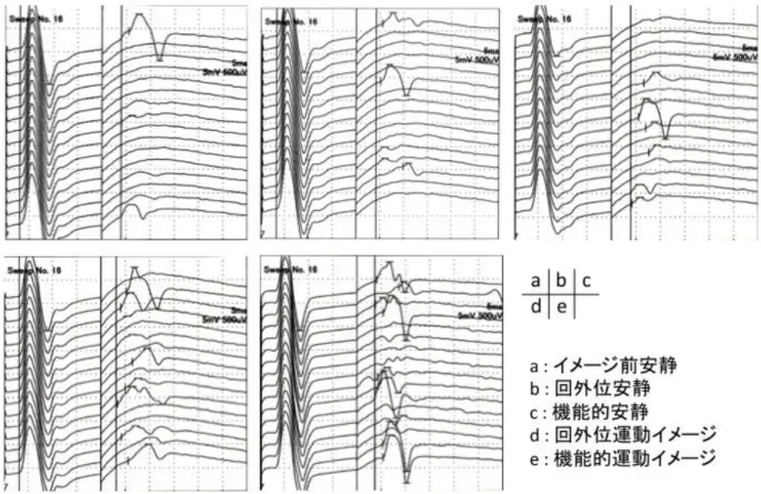 図 3 ： 各 課 題 時 の F 波 測 定 の 結 果   F 波 測 定 の 一 例 で あ る ． 初 め に M 波 が 出 現 し そ の 後 F 波 の 出 現 を 認 め る ． 機 能 的 運 動 イ メ ー ジ が も っ と も F 波 振 幅 が 大 き い こ と が 分 か る ．   2