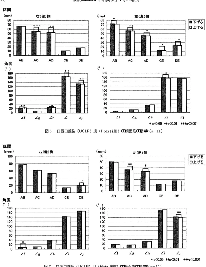 図  口唇口蓋裂（ ）児（  床無）の顔面筋の動き（  ） 図  口唇口蓋裂（ ）児（  床有）の顔面筋の動き（  ） 児の右側と比較すると ，有意差のある区間や角度が 同じであったのは  角度（  角）だけであり，健常 児の右側に比べて大頬骨筋がよく動き，口輪筋の動 きが少ないと考えられた．その理由としては ，  床装着前は吸啜のために乳首は抜裂部に陥入してい る  哺乳となりやすい ．そのため患側は口輪筋に 裂があることから口輪筋とつながっている筋に引っ張られて動きが大きく，反対に健側は患側の口輪筋に裂