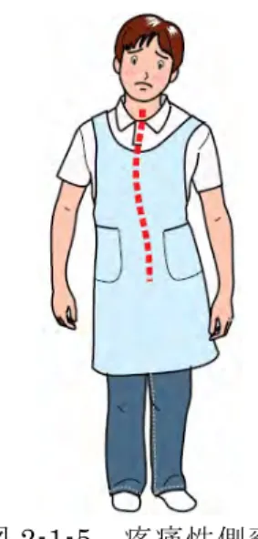 図 2-1-5  疼痛性側弯  ②  腰部脊柱管狭窄症  腰骨（腰椎）の加齢変化に伴い、腰の神経（神経根および馬尾（ばび））が圧迫 されることに起因します。高齢の方で、背筋が伸びた姿勢になる立ちっぱなしや 歩行中に足の痛みやしびれが生じ、腰が少し前かがみになる椅子に座っている時、 横向きで寝ている時、自転車に乗っている時は楽であるといった場合は本症が疑 われます。背筋を伸ばした姿勢では、腰の神経が強く圧迫され神経の血液循環が 悪くなりますが、逆に少し前かがみになると神経の圧迫が減るためです（図 2-1-6）