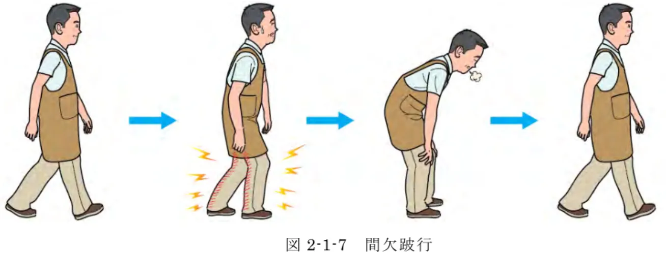 図 2-1-7  間欠跛行  （２）非特異的腰痛  多くは椎間板のほか椎間関節、仙腸関節といった腰椎の関節部分、そして背筋な ど腰部を構成する組織のどこかに痛みの原因がある可能性は高いところですが、特 異的、つまり、どこが発痛源であるかを厳密に断言できる検査法がないことから痛 みの起源を明確にはできません。骨のずれ（すべり）やヘルニアなどの画像上の異 常所見があっても、腰痛で困っていない人はいますし、逆に、腰痛の経験があって も画像所見は正常な場合もあります。つまり、画像上の異常所見は必ずしも痛みを 説明で