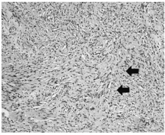 Fig. 4. Spindle cells make a palisading pattern (ar- (ar-row). Cell density is higher than Fig
