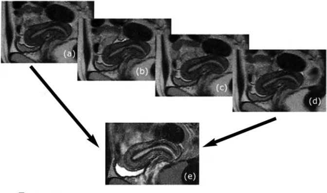 図 2. C i n e   MRI 
