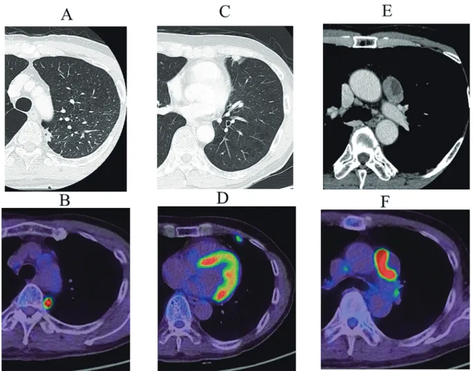 Figure 1. Computed tomography (CT) and fluorodeoxyglucose (FDG) positron emission tomography-CT findings. 