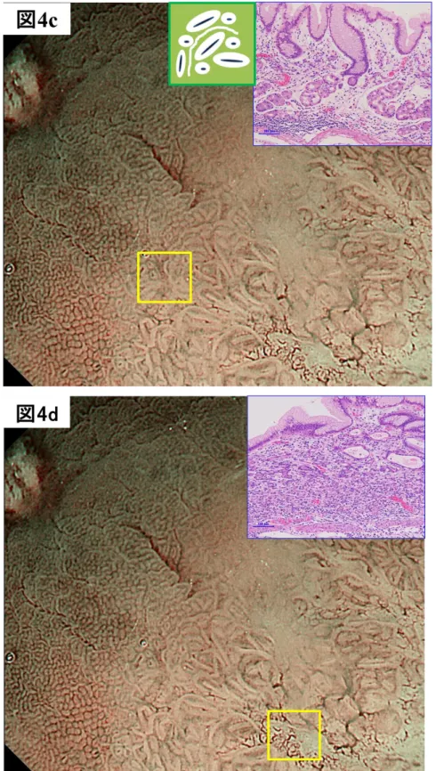 図 4d では粘膜模様は消失し、wavy micro-vessels が出現しています。組織写真のよう に癌細胞は腺窩上皮にも浸潤し腺窩が浅くなっています。このように拡大内視鏡で観察 される粘膜模様で上皮下の胃底腺の状態を推測し、癌によってどのような変化をおこし ているかもイメージすることができます。 