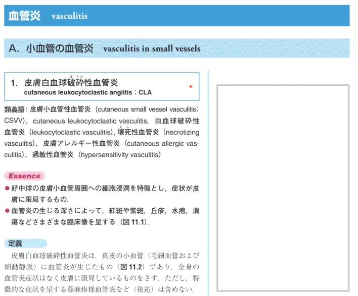 図 11.1① 皮膚白血球破砕性血管炎（ cutaneous leu- leu-kocytoclastic angiitis ） 紫斑，丘疹，結節，膿疱が混在する局面．疼痛を伴う．血管炎はその炎症の主座となる動・静脈径，およびその皮膚における深度より数種類に大別されている（図11.2参照）．皮膚の血管炎では臨床的に紫斑や潰瘍を形成することが多く，紫斑の出現によって重篤な全身性の血管炎の早期発見にもつながる場合があるため，皮膚科医の果たす役割は重要である．紫斑は，真皮ないし皮下組織への出血により，外見上赤紫色