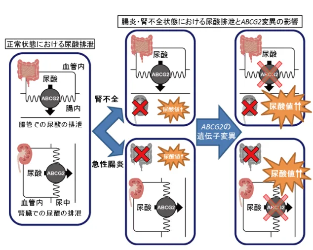 図  ABCG2 による尿酸排泄の病態生理学的モデル  健常者では、尿酸は腎臓と腸管の両者から排泄されます。血液透析などの腎不全患者さん では、腎臓からの尿酸排泄はできなくなりますので、ABCG2 の遺伝子変異による腸管の ABCG2 機能低下が尿酸値に大きく影響します。一方、急性腸炎などの消化器疾患の患者 さんでは、腸管の炎症で腸からの尿酸排泄が妨げられますので、ABCG2 の遺伝子変異に よる腎臓の ABCG2 機能低下が尿酸値に大きく影響します。 