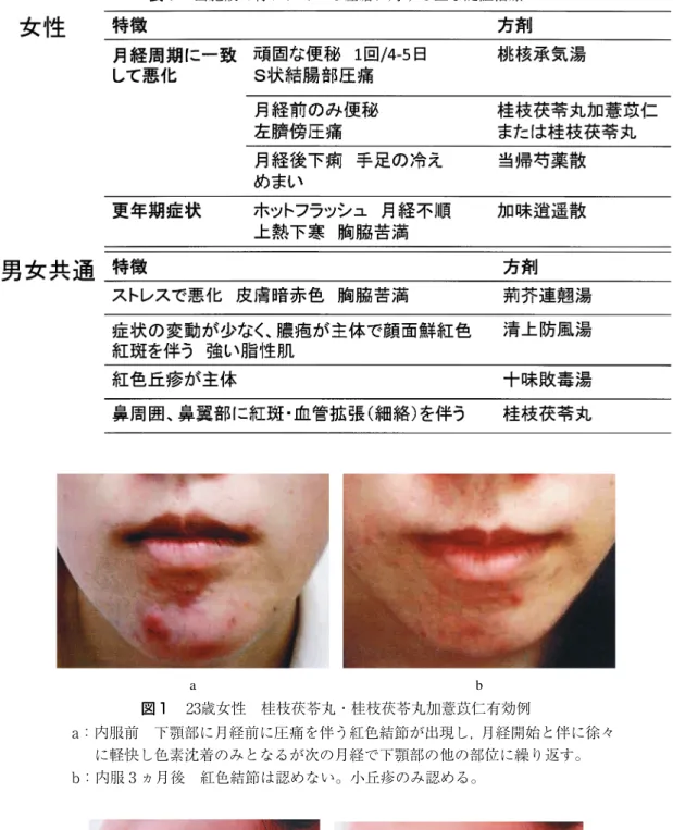 表 当施設で行われている痤瘡に対する主な随証治療 a b 図 歳女性 桂枝茯苓丸・桂枝茯苓丸加薏苡仁有効例 a：内服前 下顎部に月経前に圧痛を伴う紅色結節が出現し，月経開始と伴に徐々 に軽快し色素沈着のみとなるが次の月経で下顎部の他の部位に繰り返す。 b：内服 ヵ月後 紅色結節は認めない。小丘疹のみ認める。 a b 図 歳女性 当帰芍薬散有効例 a：内服前 両頬に比較的小さな紅色丘疹，小膿疱を認める。 b：内服 ヵ月後 丘疹，膿疱の減少を認める。