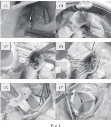 Table 3 Preoperative echocardiogram data