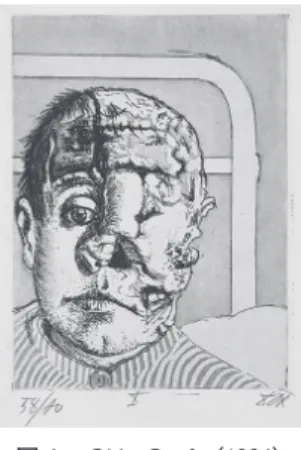 図 Skin Graft（1924）