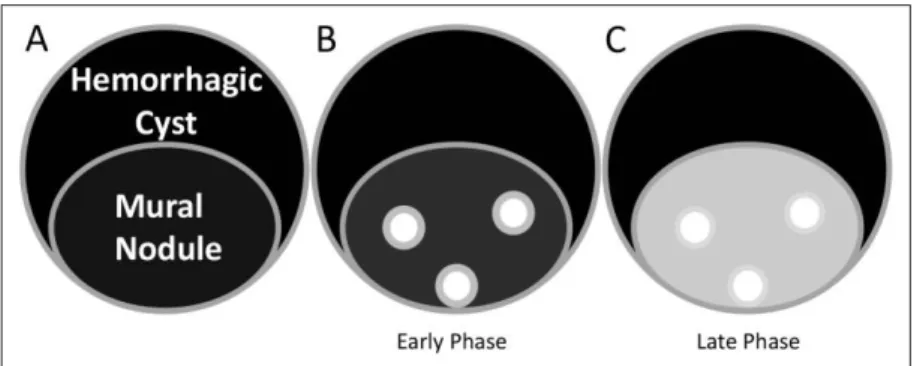 Fig. 5 Illustration of enhancement patterns of the mural nodule in the early phase (B)  and  the  delayed  phase  (C)