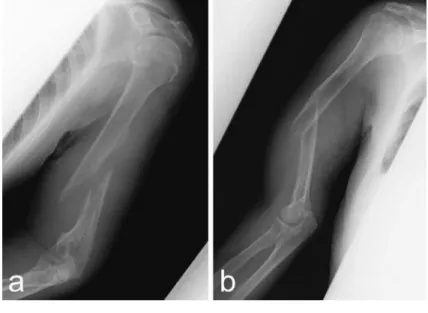 Fig. 1：上腕骨 X線写真所見 　ａ：左上腕骨骨幹部骨折を認めた． 　ｂ：左側同様に右上腕骨骨幹部骨折を認めた． Fig. 2a　腹部造影 CT：胃前庭部に造影効果を伴う壁肥厚を認めた（矢頭）．         b　腹部造影 CT ：胃幽門前庭部の壁肥厚と近傍リンパ節の腫大を認めた（白丸）．         c　上部内視鏡検査：前庭部大彎後壁に ２ 型腫瘍を認めた．         d　上部内視鏡検査：幽門前庭部小弯前壁にも ２ 型腫瘍を認めた．