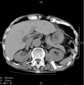 図 3   腹部 CT 所見．3 ヵ月後，血腫は縮小し，