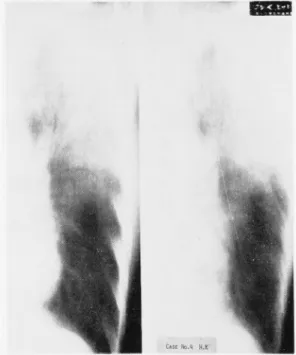 Fig.  1-(3)  Case  No.4  Its  tomographic  picture.