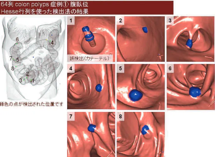 図 -8　大腸癌 CAD の例．大腸外観像上に CAD が指摘したポリープ候補の番号が記され，対応する候補画像を右に列挙してある．