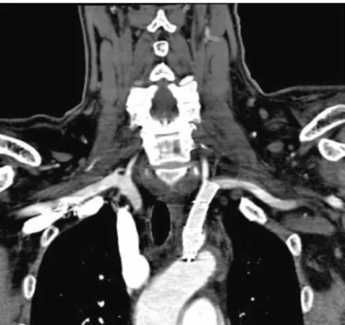 Figure 4 Magnetic resonance imaging on postoperative day 3