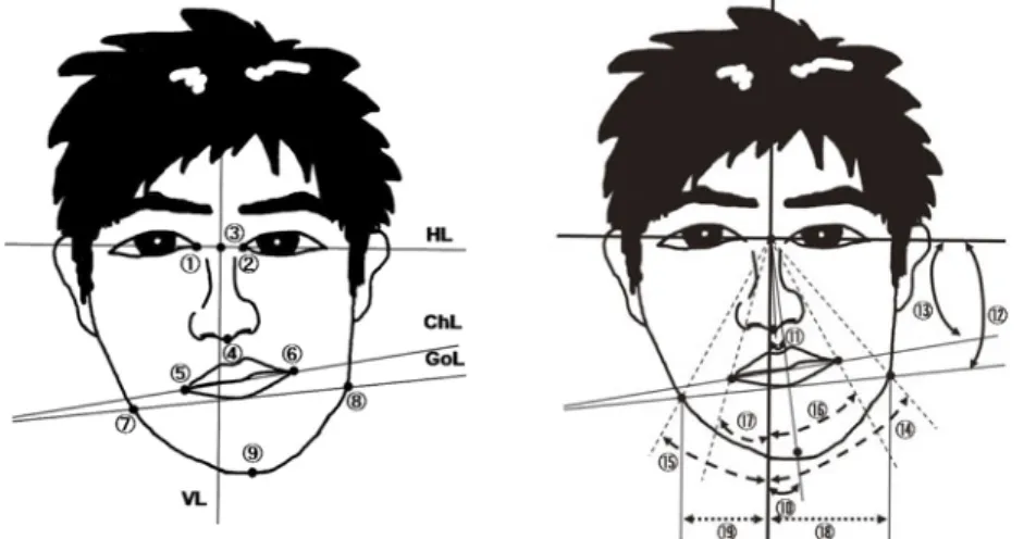 Fig. １　Landmarks, angular and linear measurements HL(horizontal line): line joining bilateral inner cathuses